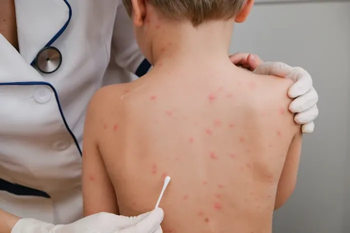 Chickenpox